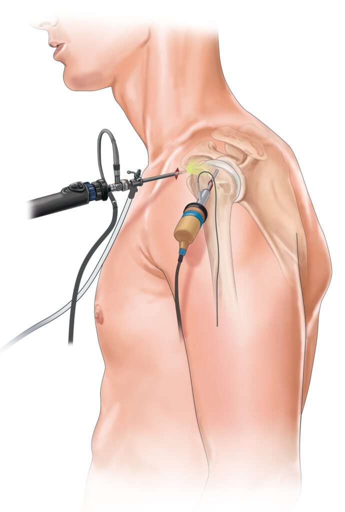 arthroscopie