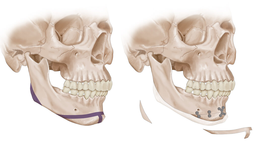 crâne chirurgie faciale vis