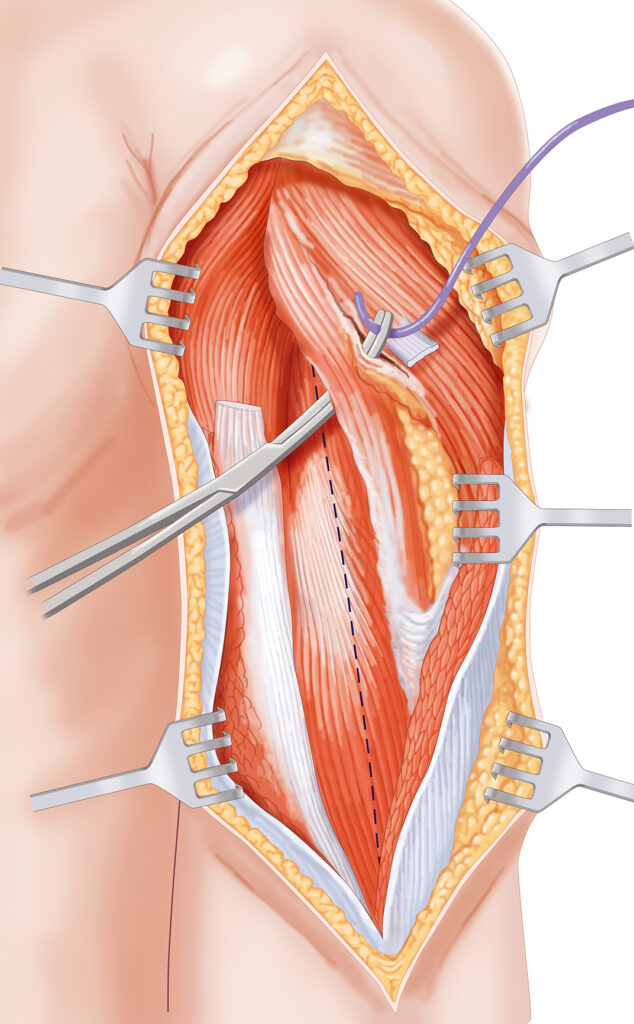 chirurgie bras écarteurs