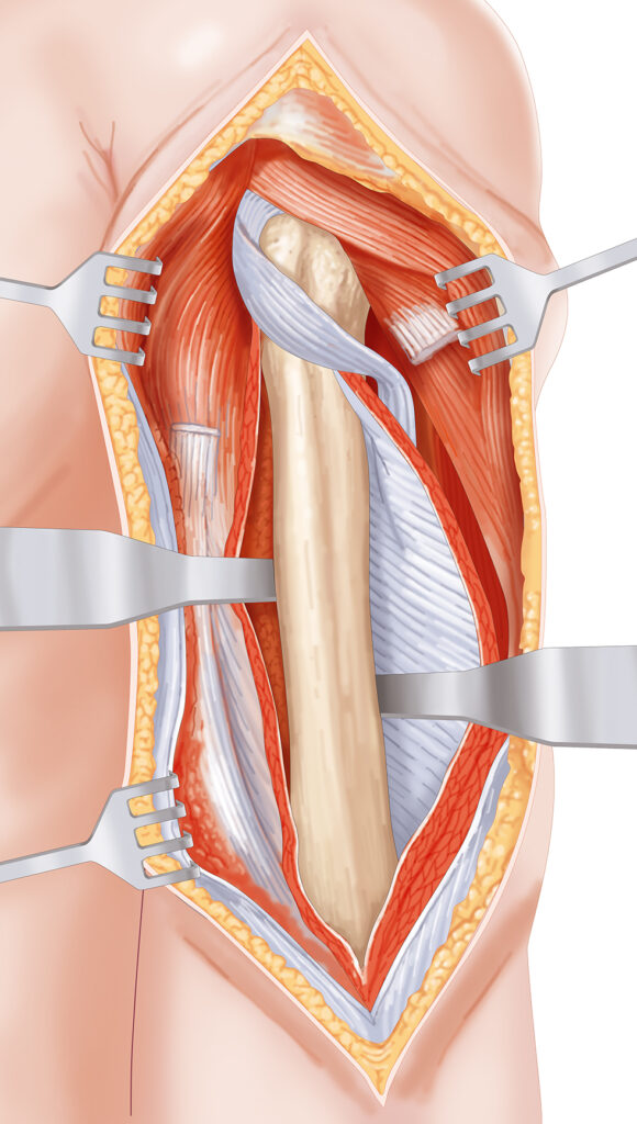 chirurgie bras écarteurs