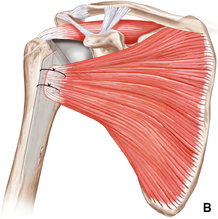 muscle subscapulaire insertion fémur prothèse