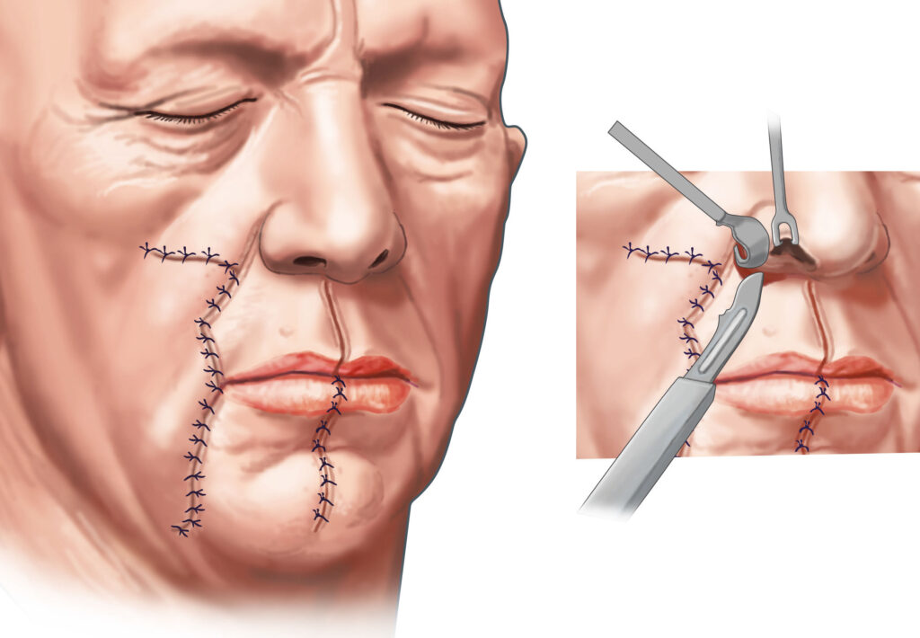 chirurgie lèvres face tête visage sutures