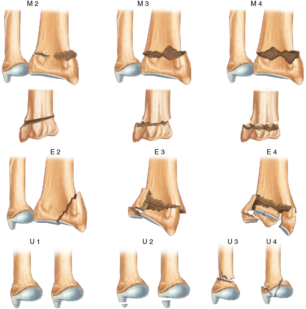 fractures radius ulna