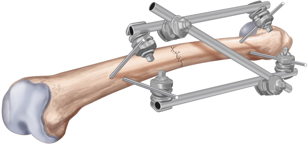 fracture fémur broche