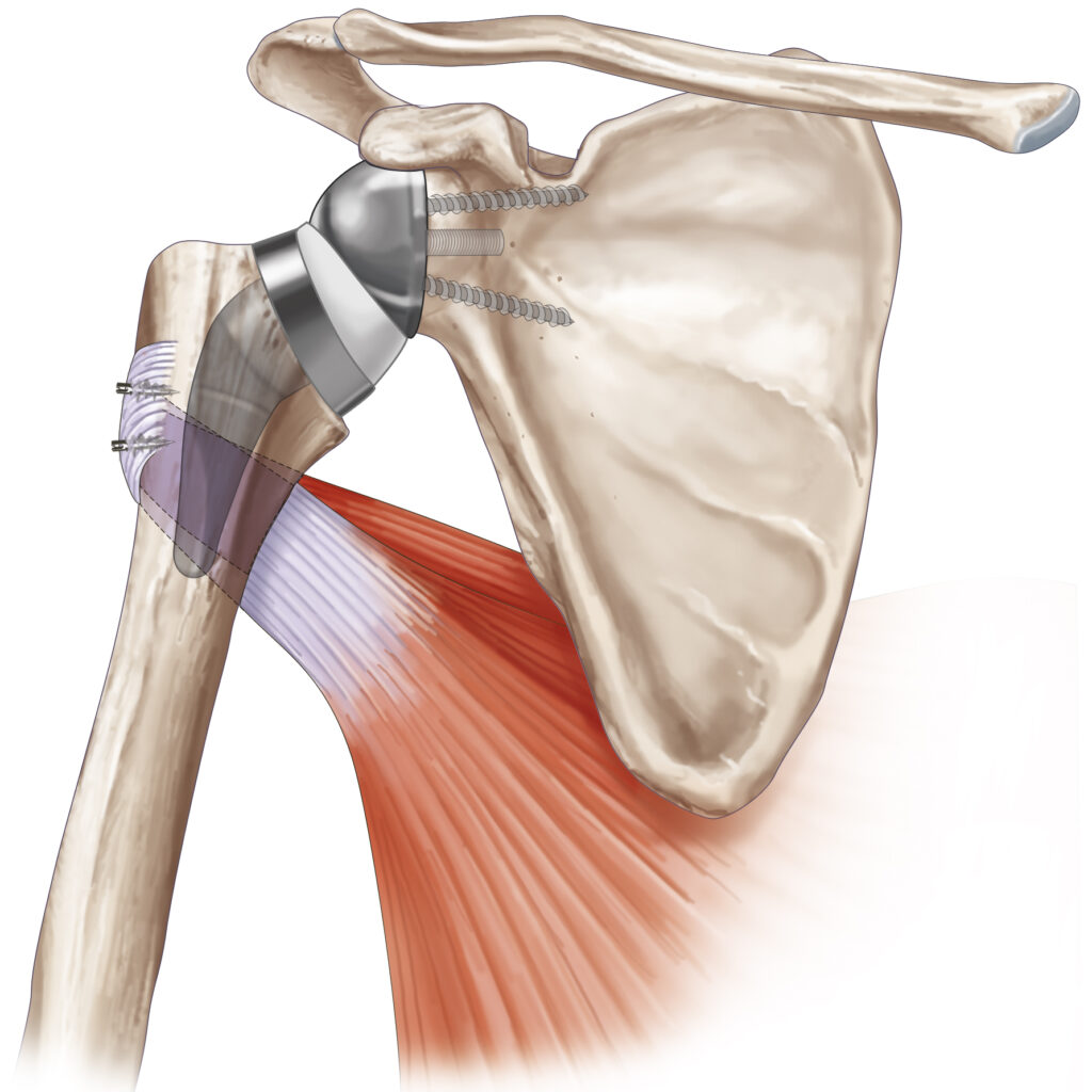 muscle subscapulaire insertion fémur prothèse